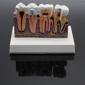 Zubné Laboratórium Mäkké Anatomické Zuby Bežné Ochorenie Model Odnímateľný Zubného Kazu Predvedenie Modelu