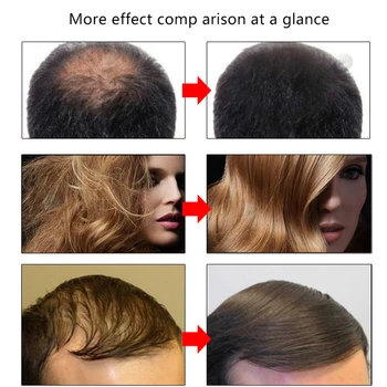 EFERO Rast Vlasov Podstate Rýchle Silné vypadávanie Vlasov Produkt Fúzy Olej Rast Sérum Éterické Oleje Rast Vlasov Liečba, Starostlivosť o Vlasy