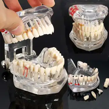 Zubné Štúdia Vyu Biele Zuby Model Vzniku Zubného Kazu Starostlivosti Ústne Vzdelávania Zubár Vybavenie Stomatologickej Starostlivosti Nástroj Ochorenia Učiteľské Študijné