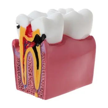 6-Krát Zubného Kazu Comparation Anatómia Zubov Model pre Zubné Laboratória Anatómie Výučby Štúdium Výskum Nástroj Zubné Model