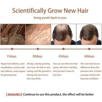 MeiYanQiong 20ML Rýchlo Silný Rast Vlasov Podstate Strata Vlasov Esenciálny Olej, Kvapalina Liečba, Prevencia vypadávania Vlasov Vlasy