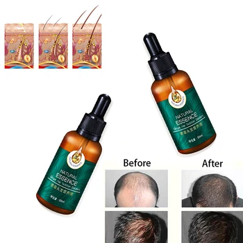 1pc 7X Rýchly Rast Vlasov Liečba Anti Hair Loss Rýchly Rast Vlasov Sérum Zázvor Esenciálny Olej 30ml