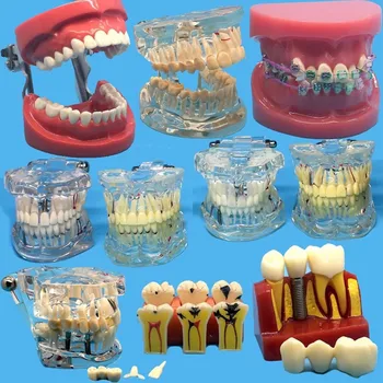 Rôzne Zubné Zuby Modely Sa Používajú Na Výučbu A Nemocnice Zubár Materiál