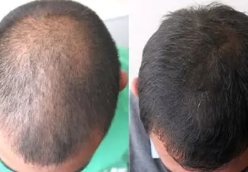 URAW MODRÉ VLASY SÉRUM (MODRÁ SERUM) %100 Hologram Pôvodnej posilňuje vlasy repair spomaľuje stratu rast podporu rýchle dodanie pomoc
